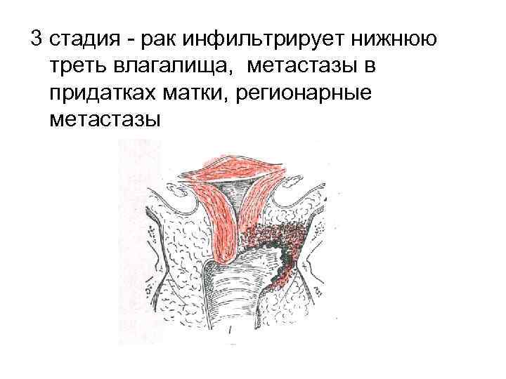 3 стадия рак инфильтрирует нижнюю треть влагалища, метастазы в придатках матки, регионарные метастазы 