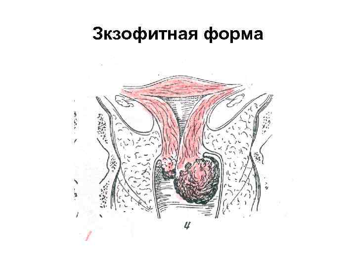 Зкзофитная форма 