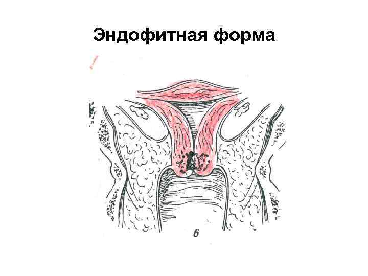 Эндофитная форма 