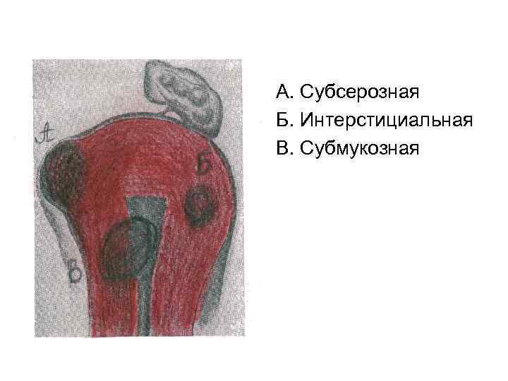 А. Субсерозная Б. Интерстициальная В. Субмукозная 