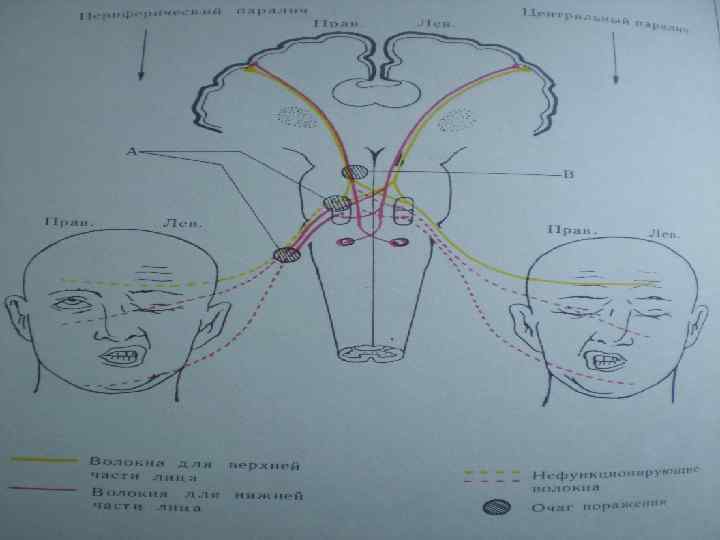 Лицевой нерв слева. Нейропатия лицевого нерва. Нейропатия левого лицевого нерва. ВР. Нейропатия лицевого нерва. Нейроваскулярный конфликт нейропатия лицевого нерва.