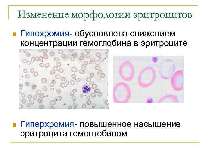 Изменение морфологии эритроцитов n Гипохромия- обусловлена снижением концентрации гемоглобина в эритроците n Гиперхромия- повышенное