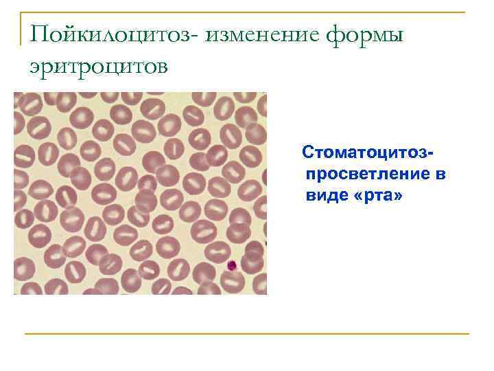 Пойкилоцитоз- изменение формы эритроцитов Стоматоцитозпросветление в виде «рта» 