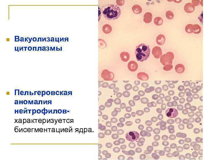 n Вакуолизация цитоплазмы n Пельгеровская аномалия нейтрофиловхарактеризуется бисегментацией ядра. 