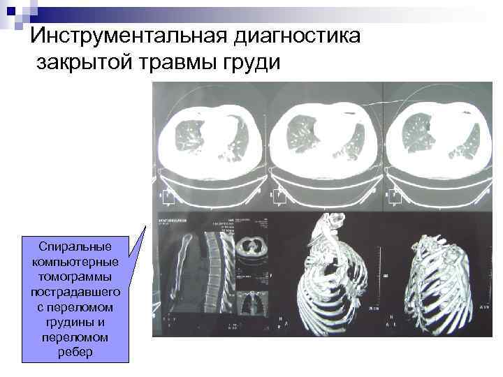 Инструментальная диагностика закрытой травмы груди Спиральные компьютерные томограммы пострадавшего с переломом грудины и переломом