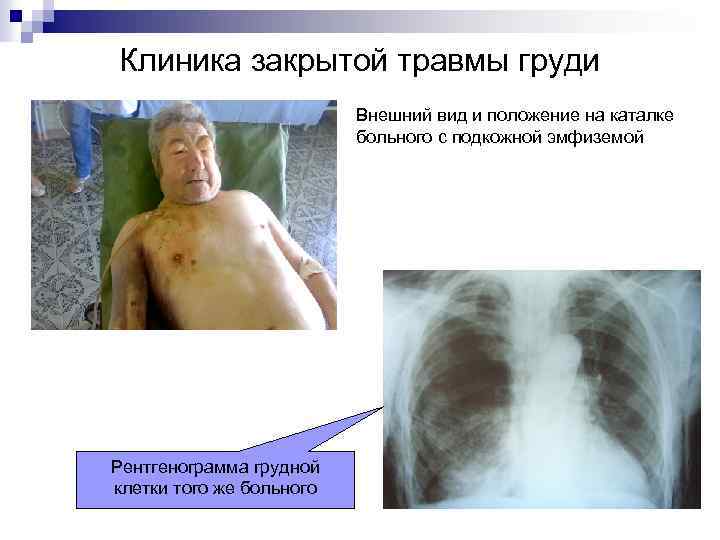 Клиника закрытой травмы груди Внешний вид и положение на каталке больного с подкожной эмфиземой