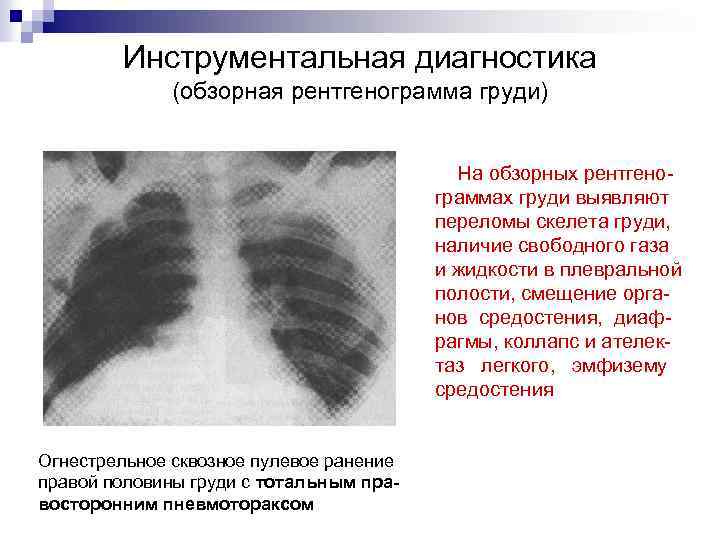 Инструментальная диагностика (обзорная рентгенограмма груди) На обзорных рентгенограммах груди выявляют переломы скелета груди, наличие