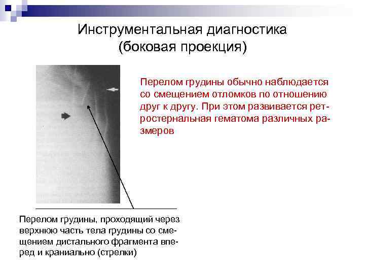Инструментальная диагностика (боковая проекция) Перелом грудины обычно наблюдается со смещением отломков по отношению друг