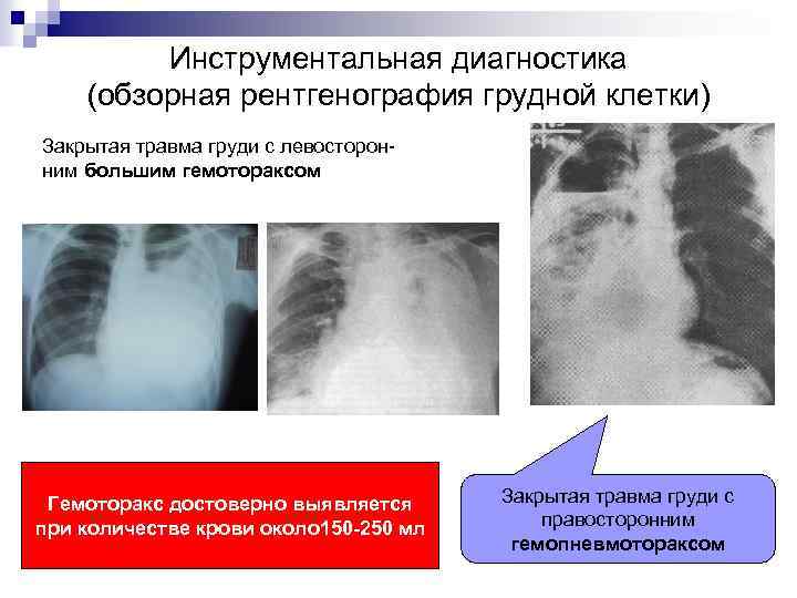 Инструментальная диагностика (обзорная рентгенография грудной клетки) Закрытая травма груди с левосторонним большим гемотораксом Гемоторакс