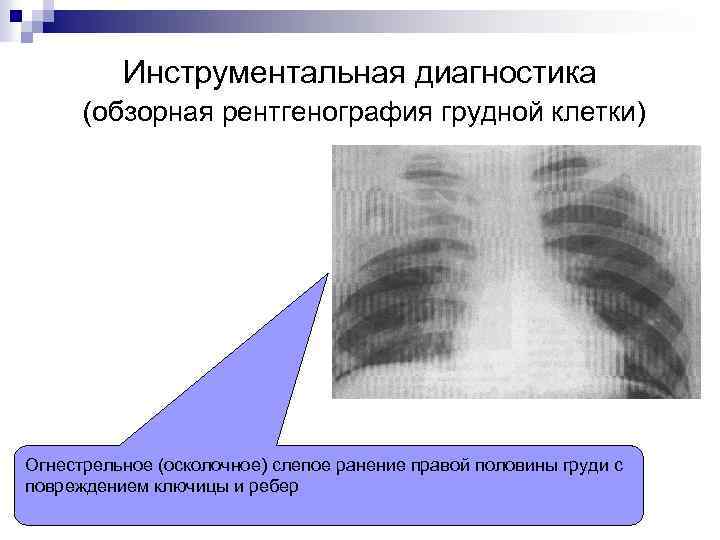 Инструментальная диагностика (обзорная рентгенография грудной клетки) Огнестрельное (осколочное) слепое ранение правой половины груди с
