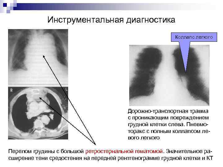 Инструментальная диагностика Коллапс легкого Дорожно-транспортная травма с проникающим повреждением грудной клетки слева. Пневмоторакс с