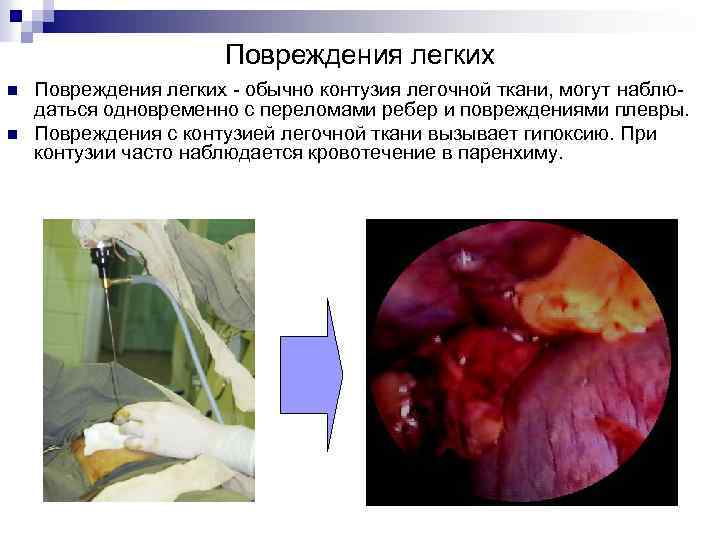 Повреждения легких n n Повреждения легких - обычно контузия легочной ткани, могут наблюдаться одновременно
