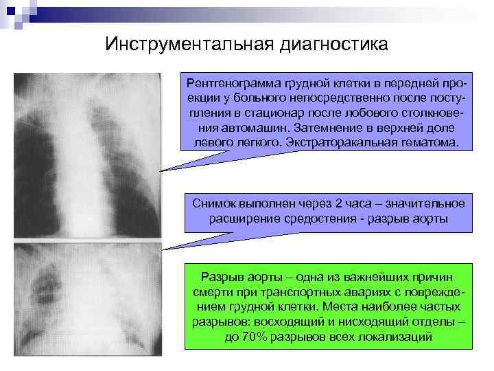 Инструментальная диагностика Рентгенограмма грудной клетки в передней проекции у больного непосредственно после поступления в