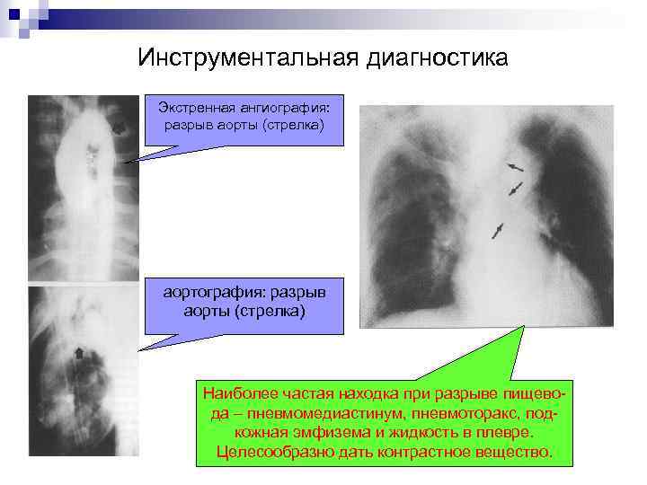Инструментальная диагностика Экстренная ангиография: разрыв аорты (стрелка) аортография: разрыв аорты (стрелка) Наиболее частая находка