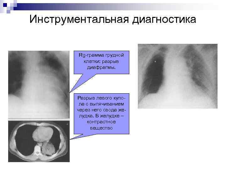 Инструментальная диагностика Rg-грамма грудной клетки: разрыв диафрагмы. Разрыв левого купола с выпячиванием через него
