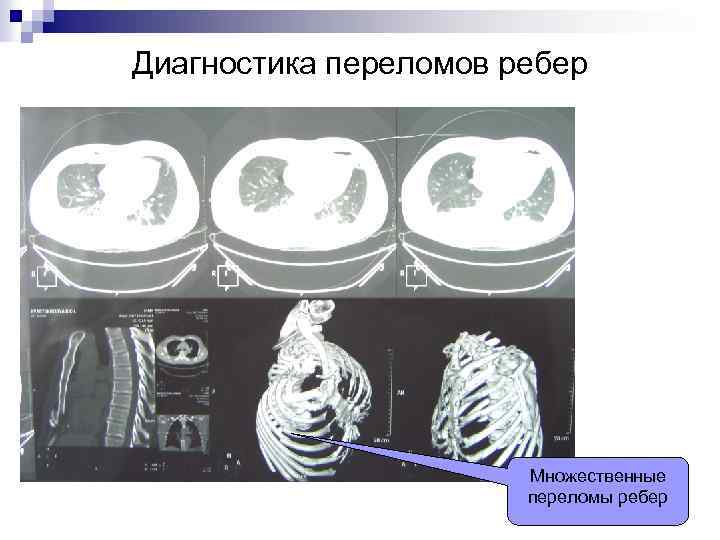 Диагностика переломов ребер Множественные переломы ребер 