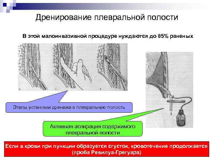 Дренирование плевральной полости. Активный дренаж плевральной полости. Способы дренирования плевральной полости. Методы дренирования плевральной полости. Виды дренирования плевральной полости.