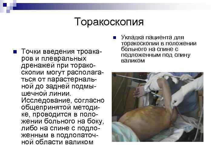 Торакоскопия n n Точки введения троакаров и плевральных дренажей при торакоскопии могут располагаться от