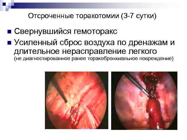 Отсроченные торакотомии (3 -7 сутки) Свернувшийся гемоторакс n Усиленный сброс воздуха по дренажам и