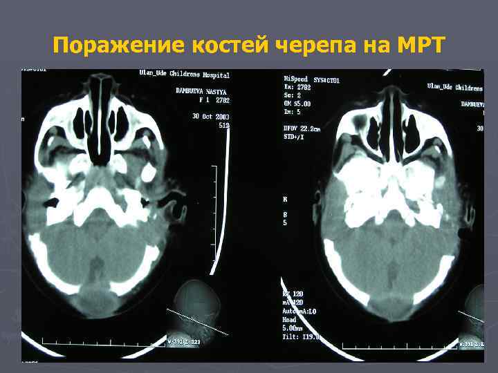 Поражение костей черепа на МРТ 