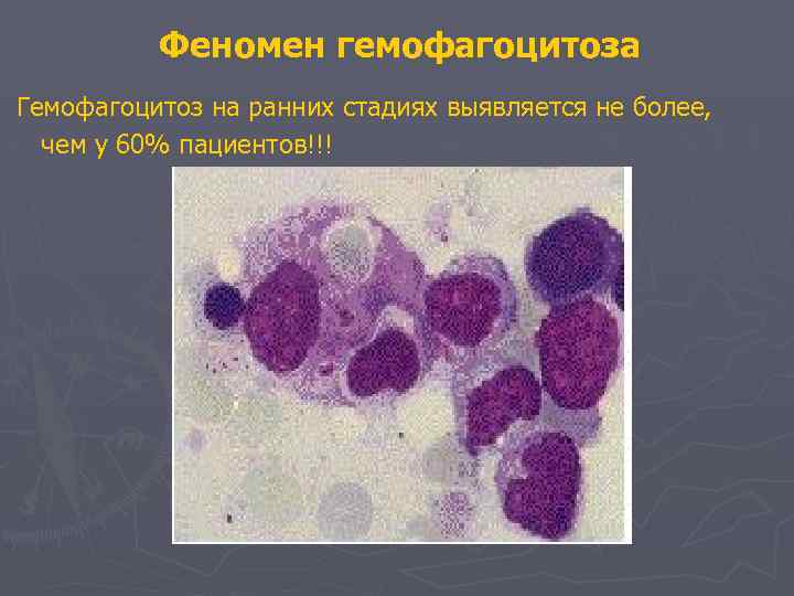 Феномен гемофагоцитоза Гемофагоцитоз на ранних стадиях выявляется не более, чем у 60% пациентов!!! 