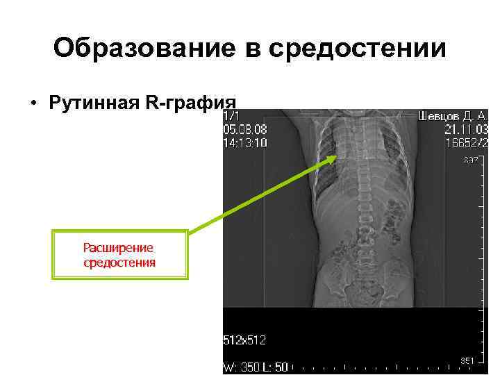 Образование в средостении • Рутинная R-графия Расширение средостения 