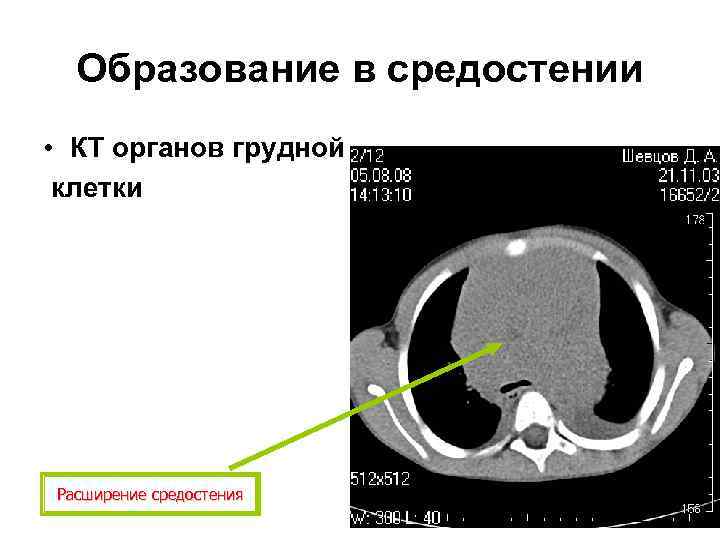 Образование в средостении • КТ органов грудной клетки Расширение средостения 