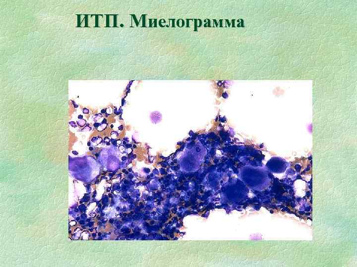 ИТП. Миелограмма 