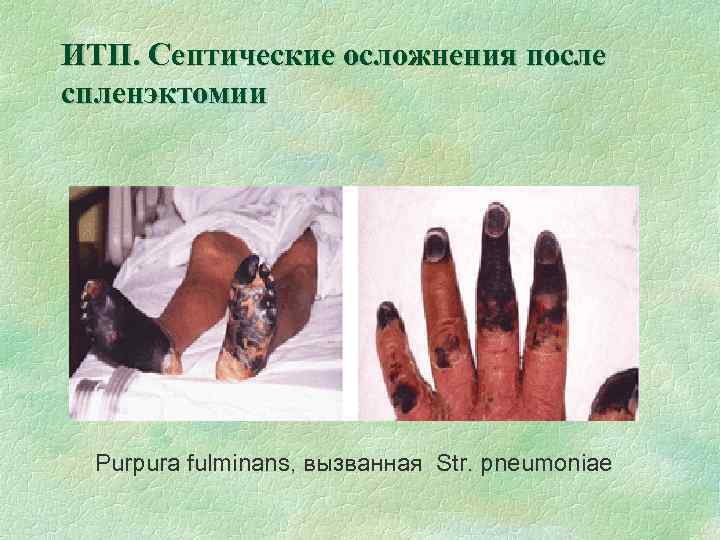 ИТП. Септические осложнения после спленэктомии Purpura fulminans, вызванная Str. pneumoniae 