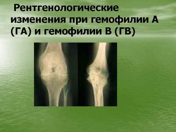 Рентгенологические изменения при гемофилии А (ГА) и гемофилии В (ГВ) 