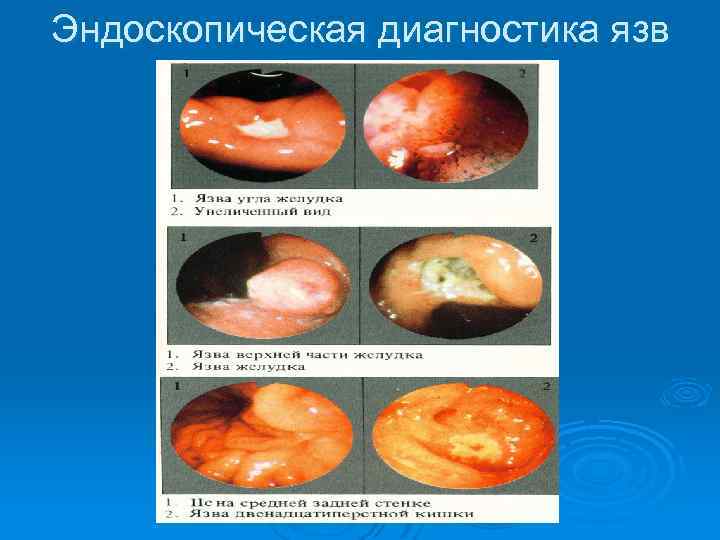 Эндоскопическая диагностика язв 