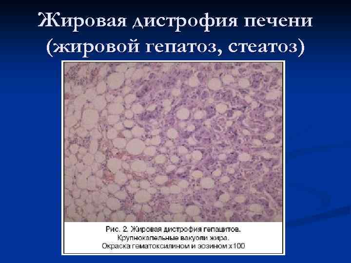 Жировая дистрофия печени (жировой гепатоз, стеатоз) 