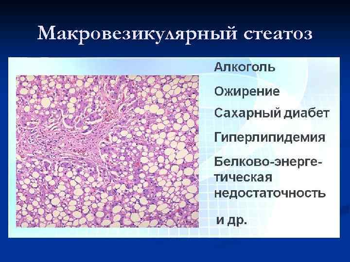 Макровезикулярный стеатоз 