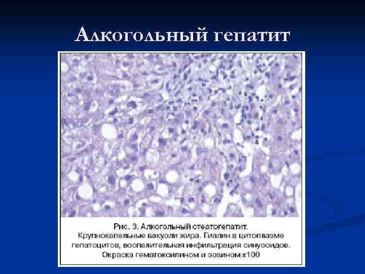 Алкогольный гепатит 