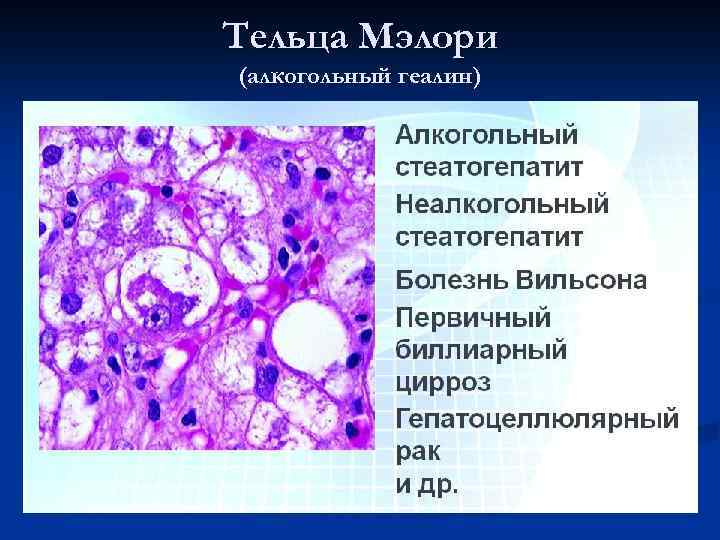 Тельца Мэлори (алкогольный геалин) 
