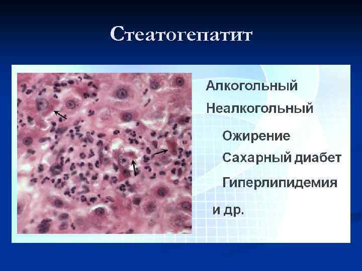 Стеатогепатит 