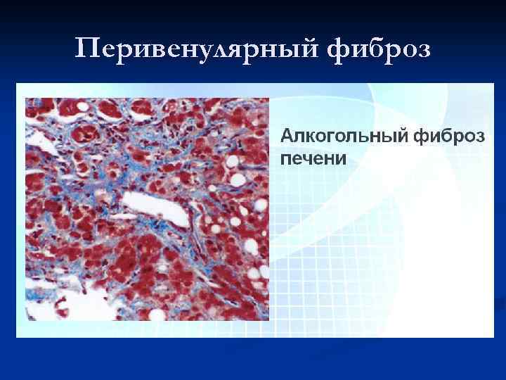 Перивенулярный фиброз 