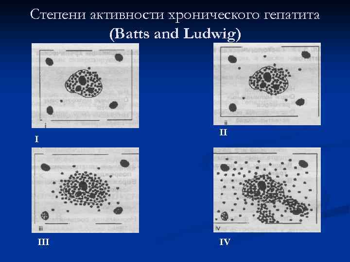 Степени активности хронического гепатита (Batts and Ludwig) I II IV 