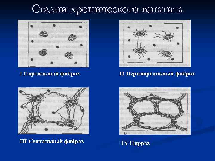 Стадии хронического гепатита I Портальный фиброз II Перипортальный фиброз III Септальный фиброз IY Цирроз