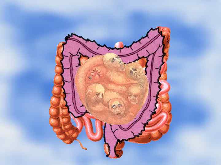 Синдром раздраженного кишечника Функциональное кишечное расстройство, при котором Синдром раздраженного кишечника Функциональное кишечное расстройство, при котором