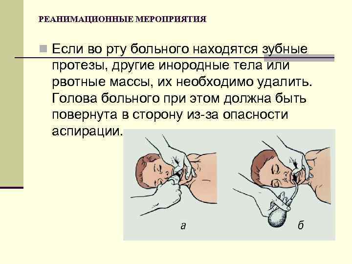 РЕАНИМАЦИОННЫЕ МЕРОПРИЯТИЯ n Если во рту больного находятся зубные протезы, другие инородные тела или