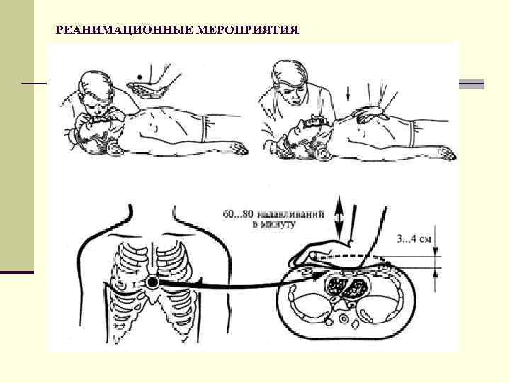 РЕАНИМАЦИОННЫЕ МЕРОПРИЯТИЯ 