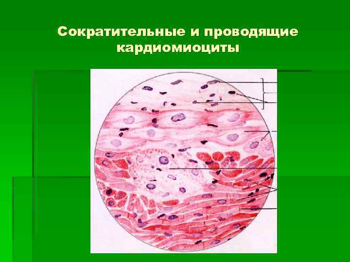 Атипичные кардиомиоциты рисунок