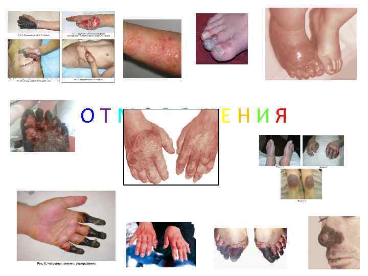 ОТМОРОЖЕНИЯ 