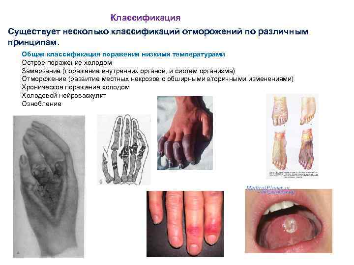 Классификация Существует несколько классификаций отморожений по различным принципам. Общая классификация поражения низкими температурами Острое