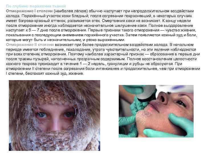 По глубине поражения тканей Отморожение I степени (наиболее лёгкое) обычно наступает при непродолжительном воздействии