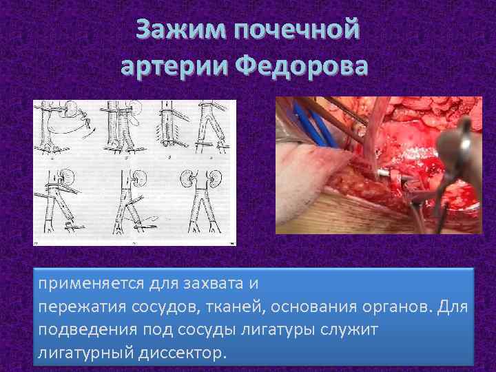 Зажим почечной артерии Федорова применяется для захвата и пережатия сосудов, тканей, основания органов. Для