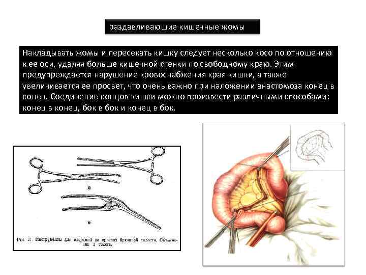 раздавливающие кишечные жомы Накладывать жомы и пересекать кишку следует несколько косо по отношению к
