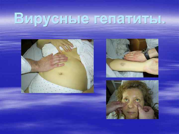 Вирусные гепатиты. 