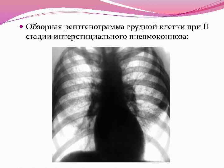  Обзорная рентгенограмма грудной клетки при II стадии интерстициального пневмокониоза: 